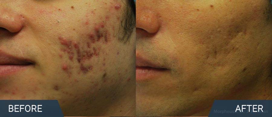 Acne scar treatment and Acne scars / scaring removal