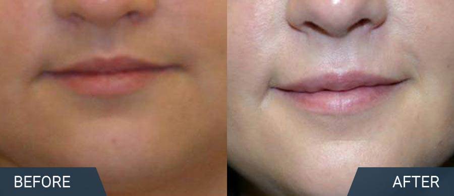 Juvederm Ultra XC Wrinkle Removal and Skin tightening | Wolpoe Facial Plastics Serving Bozeman, Belgrade, Livingston and Big Sky